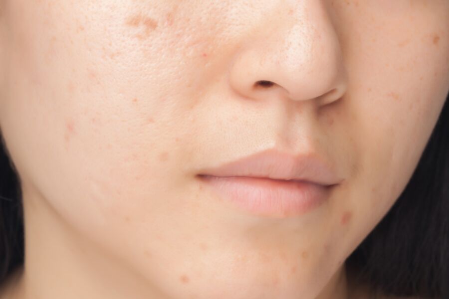 Acne Scar Skin